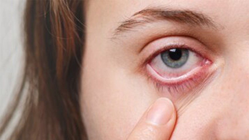 Göz Eti (Peterjium) Ameliyatı Nasıl Yapılır?