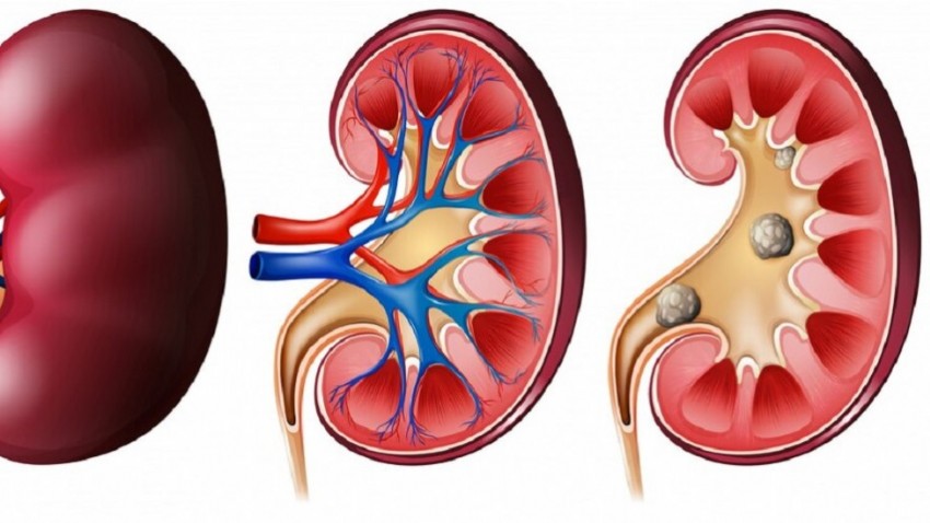 Böbrek Taşı Düşürme Belirtileri Nelerdir?